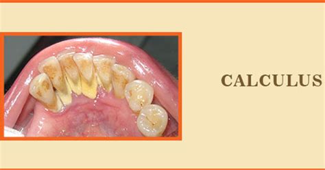 Calculus (Dental) - Symptoms, Causes, Treatment in India