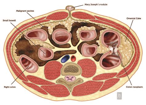 Sister Mary Joseph Nodule
