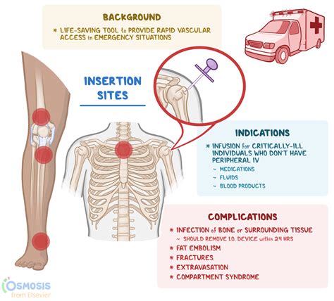 Intraosseous (IO) Device: What Is It, Risks and Benefits, and More ...