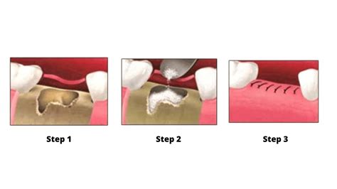 Bone graft after tooth extraction: Techniques, alternatives, healing, and more