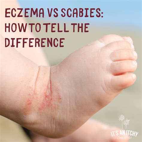 What's the Difference Between Eczema vs. Scabies? | It's an Itchy Little World