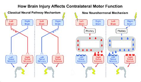Image result for Contralateral Brain Injury