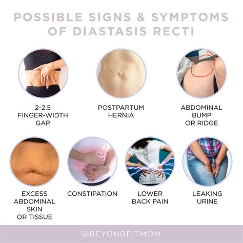 Possible signs and symptoms of diastasis recti | Diastasis recti, Diastasis, Mom tummy