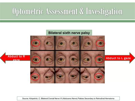 Sixth nerve palsy