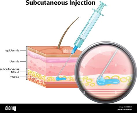 Intradermal vs Subcutaneous Injection 的图像结果