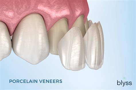 Veneers Cost - Top 8 Factors That Affect Cost and How To Save