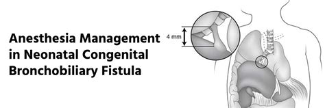 Anesthesia management in neonatal congenital bronchobiliary fistula
