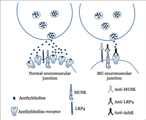 Myasthenia Gravis and Thymoma Surgery: A Clinical Update for the ...