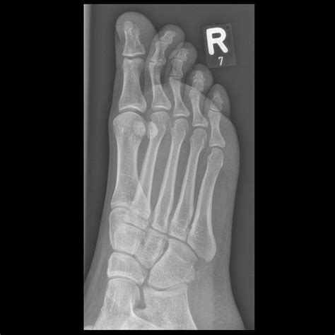 Normal Foot 的图像结果