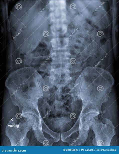 Image result for Normal Intravenous Pyelogram