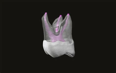 Endo Tooth #27 | V-Invent
