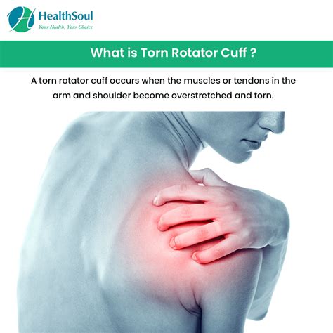 Rotator Cuff Tear Symptoms Treatment And Exercises
