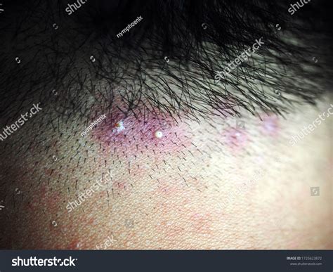 Inflamed Pus Pimples On Head Scalp Stock Photo 1725623872 | Shutterstock