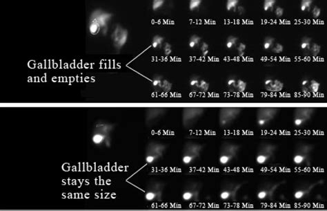 Image result for Hida Scan Explained