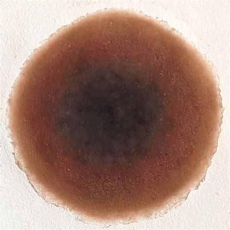 Image result for Deep Tissue Injuries