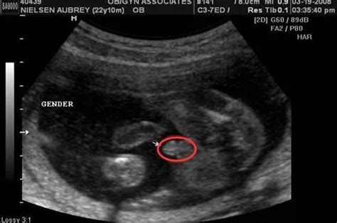 谁会看三个多月（14周）B超图的，帮我看看是男宝还是女宝！？14周妊辰，单活胎 胎儿胎头职上，双顶 - 百度宝宝知道