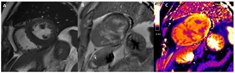 Cardiac Magnetic Resonance in Heart Failure: Diagnostic and Prognostic ...
