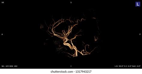 Image result for Maximum Intensity Projection Python