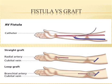 Vascular access surgery by Dr. Ali Mujtaba | PPTX