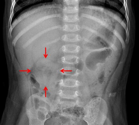 Case #11 - CaseStacks.com