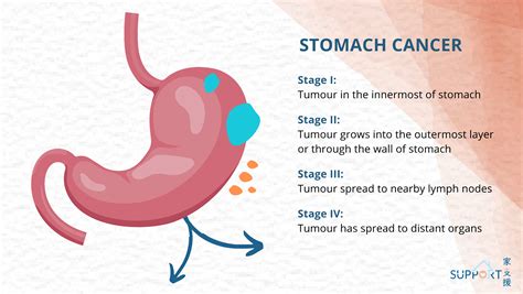 Stomach Cancer Do You Know The Signs Of Stomach Cancer? 🤔 Stomach
