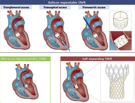 Different Types Of Tavr Valves at Lyn Romano blog