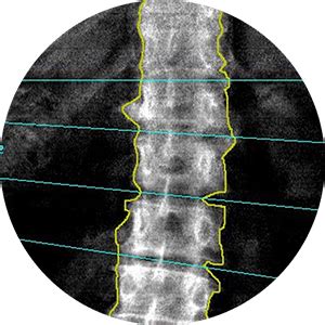 DEXA Scan | Bone Density Test | AIOR | Patna