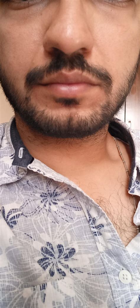 facial puffiness, under eye bags and swelling around lower lip and chin. Been on topical Min 5% ...