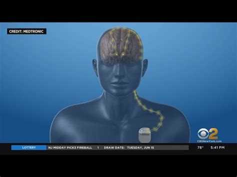 Deep Brain Stimulation (DBS) Surgery in India