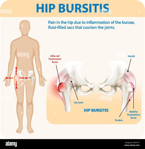 Illustration of hip bursitis and affected areas Stock Vector Image & Art - Alamy