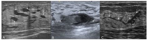 Progress in Ultrasound Research on Non-Mass Breast Lesions: Definition ...