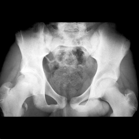 Avulsion Fracture Hip Iliac Crest