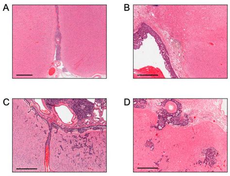 Cancers | Special Issue : From Progression to Metastasis of Solid Cancer