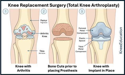 Knee Replacement Surgery-Total Knee Arthroplasty - Knee Education