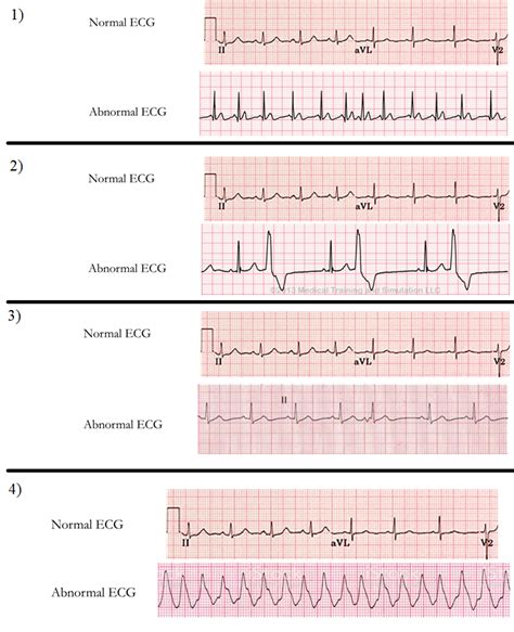Image result for Normal vs Abnormal ECG