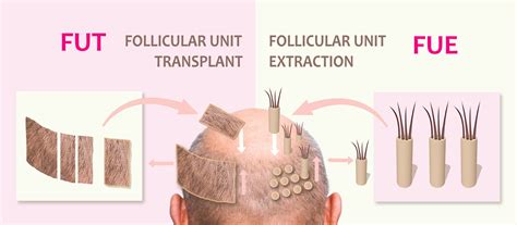 FUT vs FUE Hair Transplant: What You Should Know - Clinic Dermatech