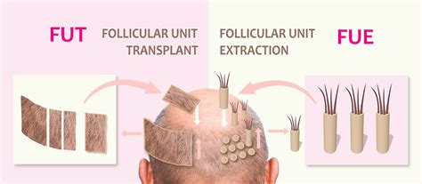 Hair Transplant in New Zealand vs Turkey: Cost, Procedures - Estenove
