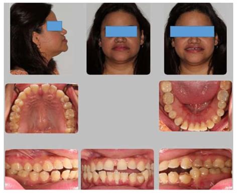 The Use of High Frequency Vibration and Clear Aligners in Management of ...