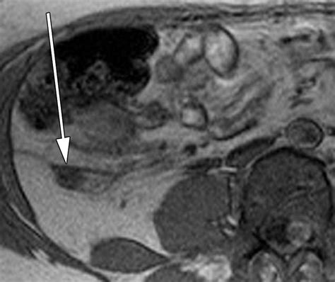 MRI for Clinically Suspected Appendicitis During Pregnancy | AJR
