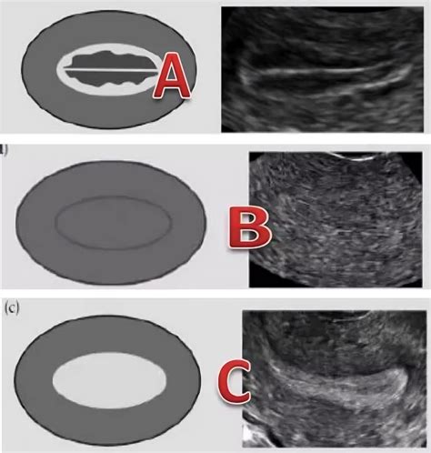 Image result for Endometrium