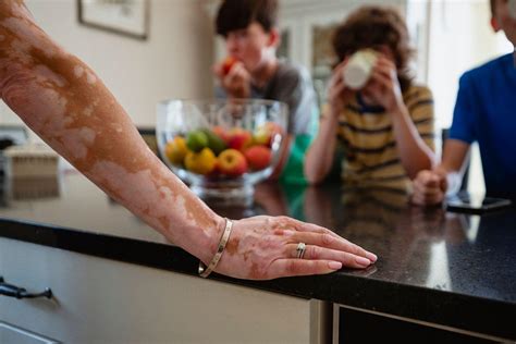 Vitiligo, la enfermedad de la piel que a pesar de ser común es muy poco ...