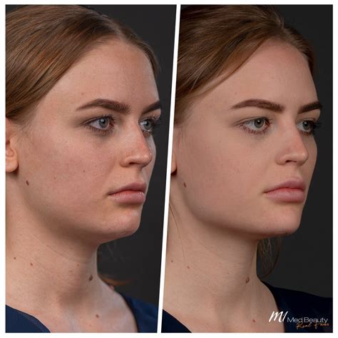 Jawline filler | Jawline augmentation with dermal filler | M1 Med Beauty