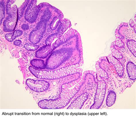 Polyps In Colon Tubular Adenoma at Daniel Isaac blog