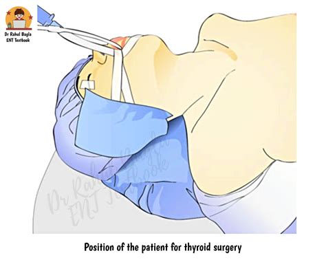 Thyroidectomy - "Thyroid Surgery Demystified: Everything You Need to Know About Thyroidectomy ...