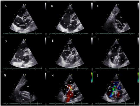 Complete Transthoracic Echocardiography for the Assessment and Guidance of Percutaneous Atrial ...