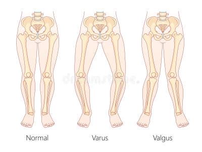 Image result for Normal Leg Alignment