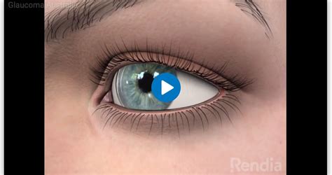 Laser Treatment | Glaucoma Australia