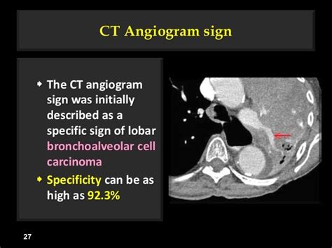 Image result for Negative Sulcus Sign