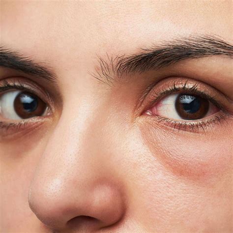 Under Eye Dark Circles and Puffiness - the causes and treatments - Reviva Labs