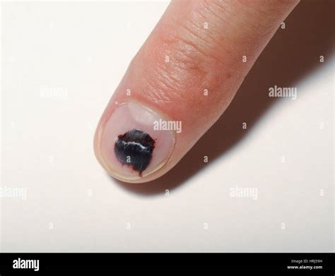 Bruised fingernail hi-res stock photography and images - Alamy